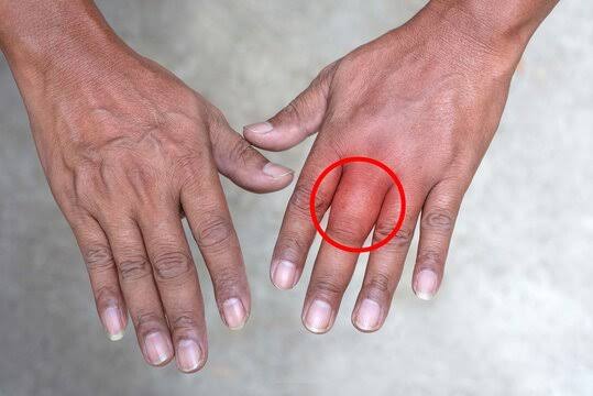 Fingers Swelling: सर्दी में उंगलियों में आ रही सूजन, तो करें ये काम, मिलेगा दर्द से आराम